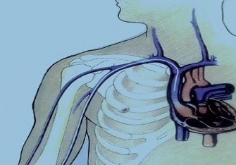 为什么人们偏爱双腔中心静脉导管？
